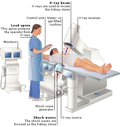 ESWL (Extracorporeal shock wave lithotripsy) –  Informatii pentru pacient