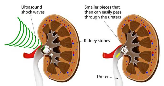 ESWL (Extracorporeal shock wave lithotripsy)