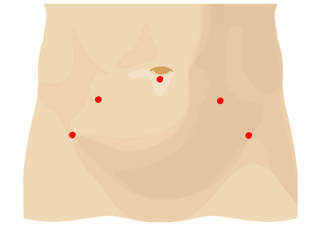 Robot-assisted Radical Prostatectomy 02